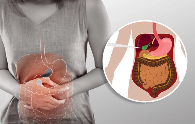 GallBladder surgery or cholecystectomy is a procedure to remove your gallbladder. Surgeons perform it through minimally invasive surgery.