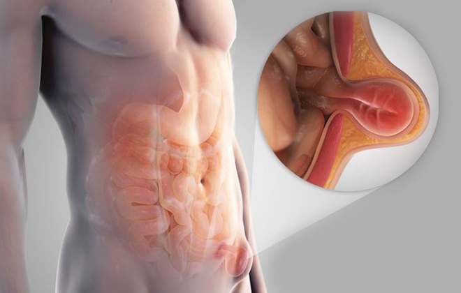 An inguinal hernia occurs when tissue, such as part of the intestine, protrudes through a weak spot in the abdominal muscles.